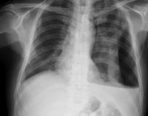 Aidoc Secures FDA Breakthrough Designation for Generative AI Diagnostic Tool First Read to Automate Chest X-ray Reporting and Clinical Workflows