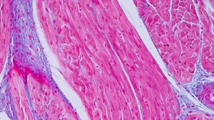 Medtronic Strategic Investment in CoreMap Aims to Revolutionize High-Resolution Mapping for Atrial Fibrillation Treatment