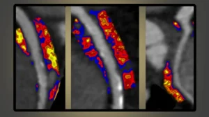 Caristo wins FDA authorization for cardiovascular risk predictor